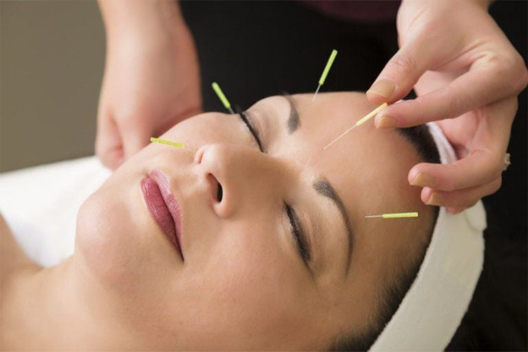 Điện mãng châm điều trị liệt nửa người